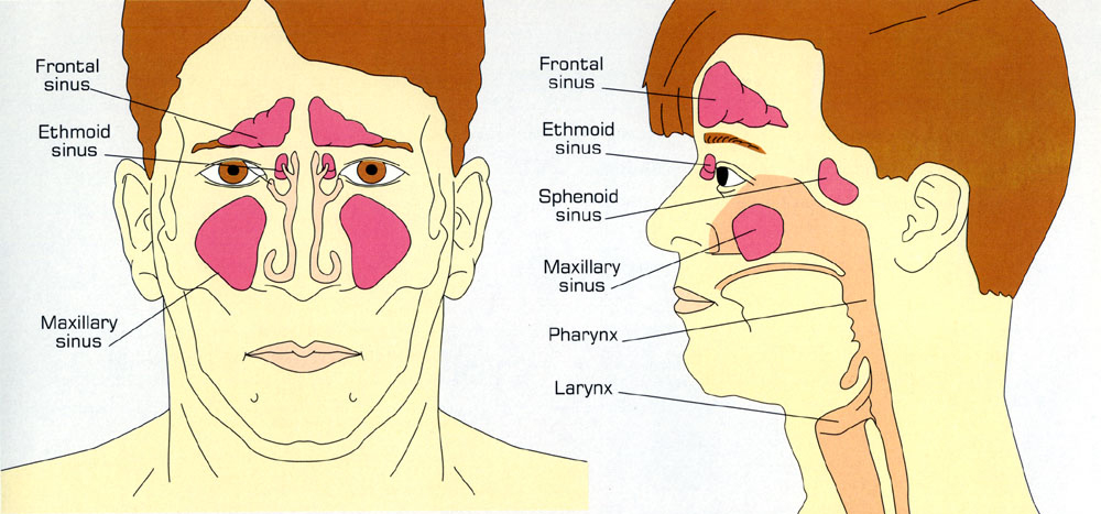 Rhinosinusitis Photos Aaaai 